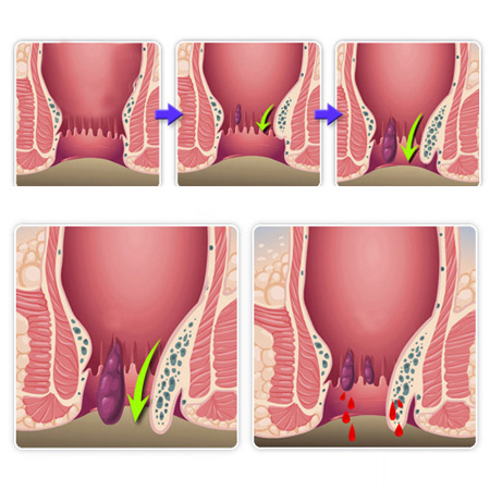 內(nèi)痔脫出怎么辦？