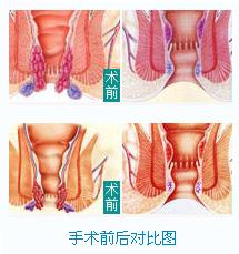 內(nèi)痔術(shù)前與術(shù)后對(duì)比圖